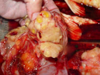 the tumor had encased all the organs in the abdomen, the gall bladder, the liver, and the intestinal track
